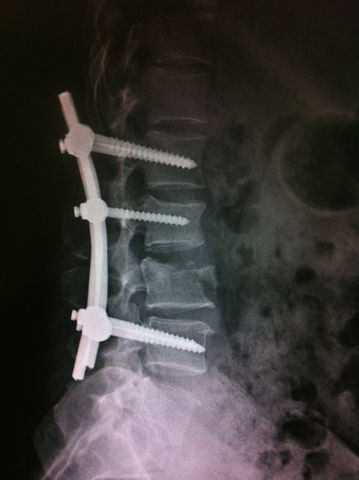 Fractura de L1, L2, L3 y L4