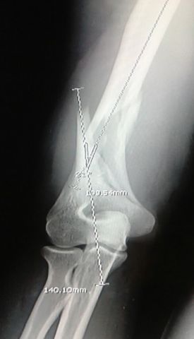 Fractura humeral compleja