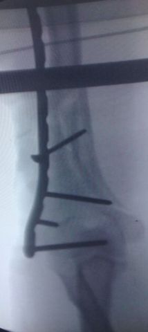 Resultado satisfactorio de fractura humeral compleja