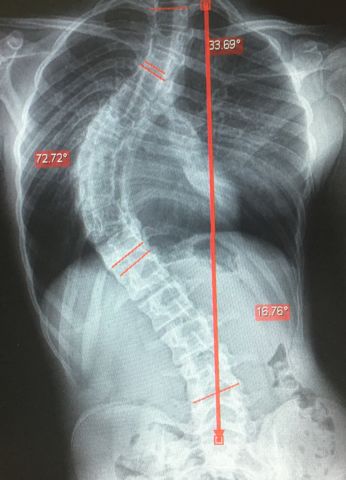 Escoliosis 70 grados