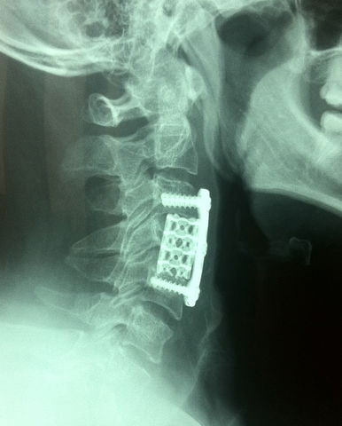 Mielopatía cervical
