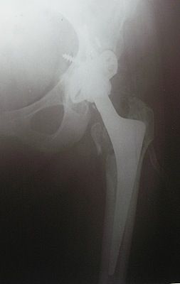 Cirugía de revisión acetabular