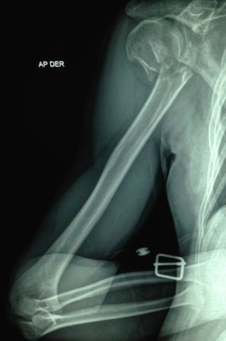 Fractura de extremo proximal humeral