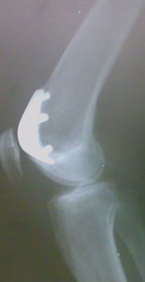 Prótesis patelofemoral