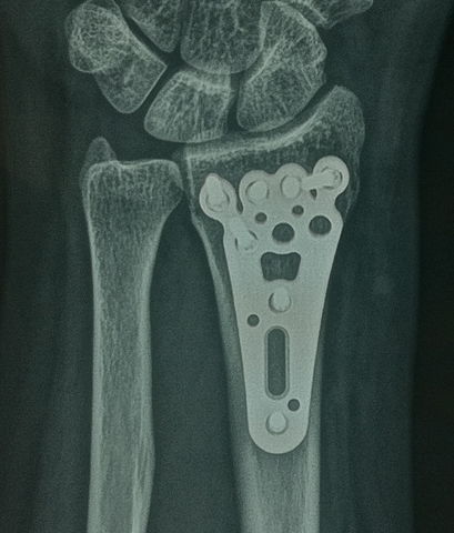 Fractura de radio distal