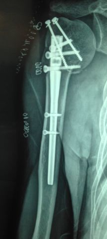 Clavo centromedular de fractura proximal humeral