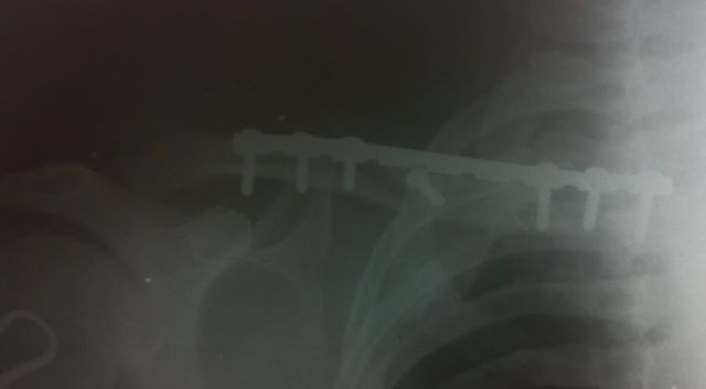 Cirugía de fractura de clavícula con placa y tornillos