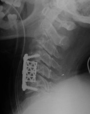 Fractura cervical instrumentada