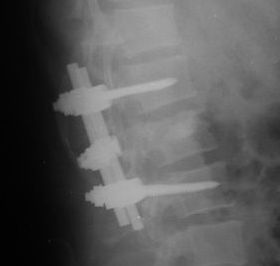 Fractura lumbar instrumentada