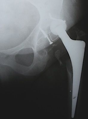 Acetábulo inestable 